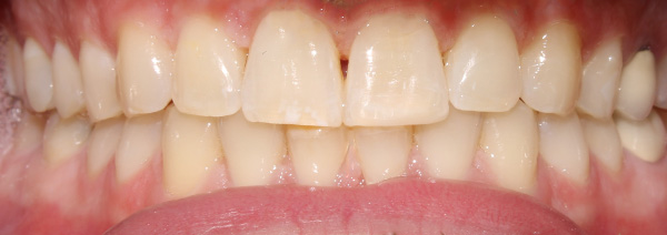 combination of orthodontic clear aligner therapy and chipped tooth repair Novi, MI