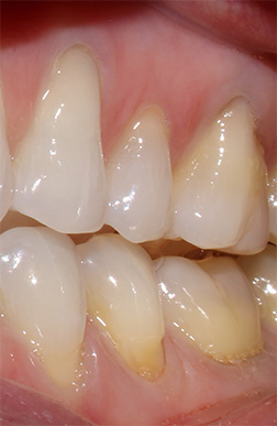 stained abfraction- class V stains restoration, gumline lesion Novi, MI